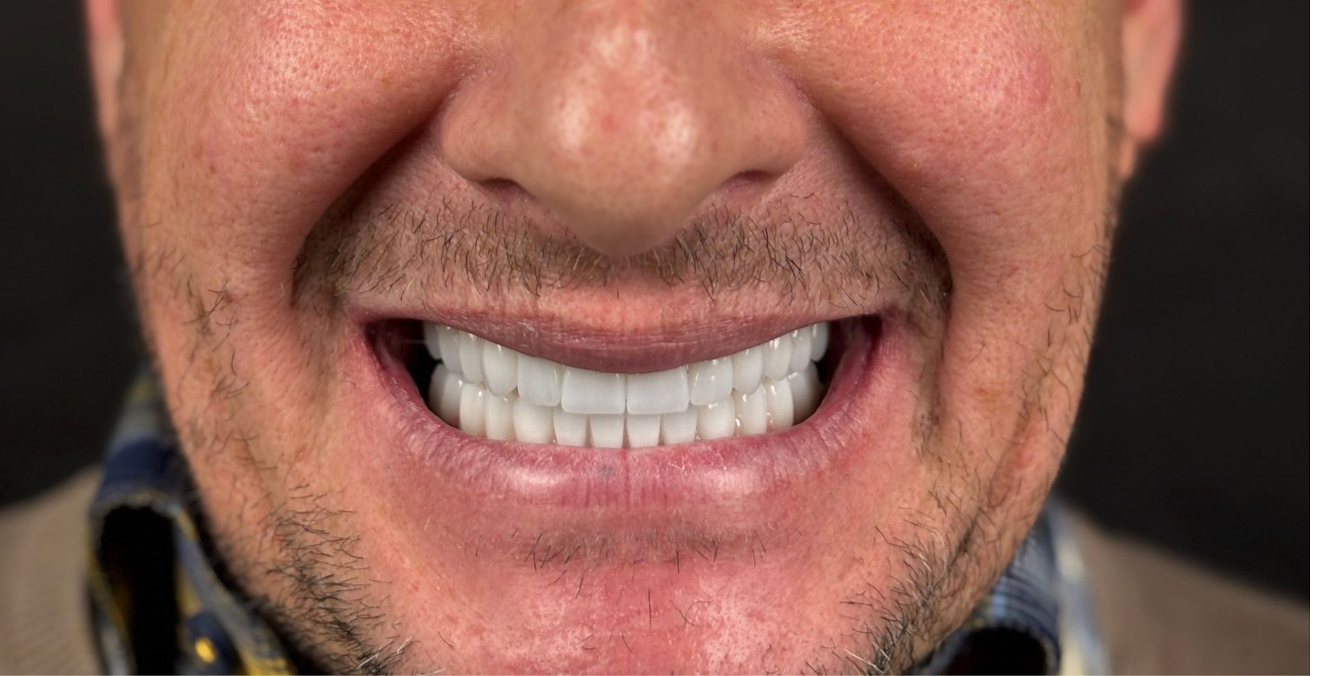 Smile design estetică dentară MD Dental Pitești, rezultat după tratament