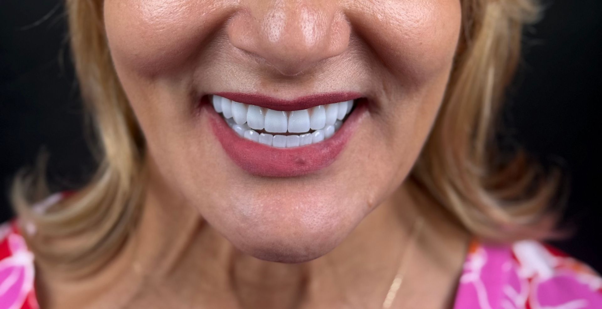 Reabilitare completă multidisciplinară MD Dental Pitești, rezultat