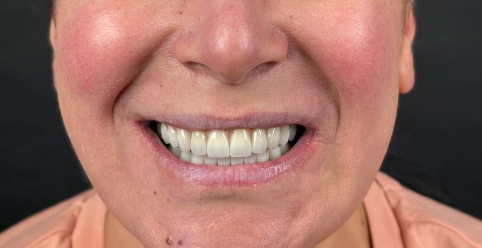 Reabilitare arcadă cu implanturi la MD Dental Pitești, rezultat după tratament