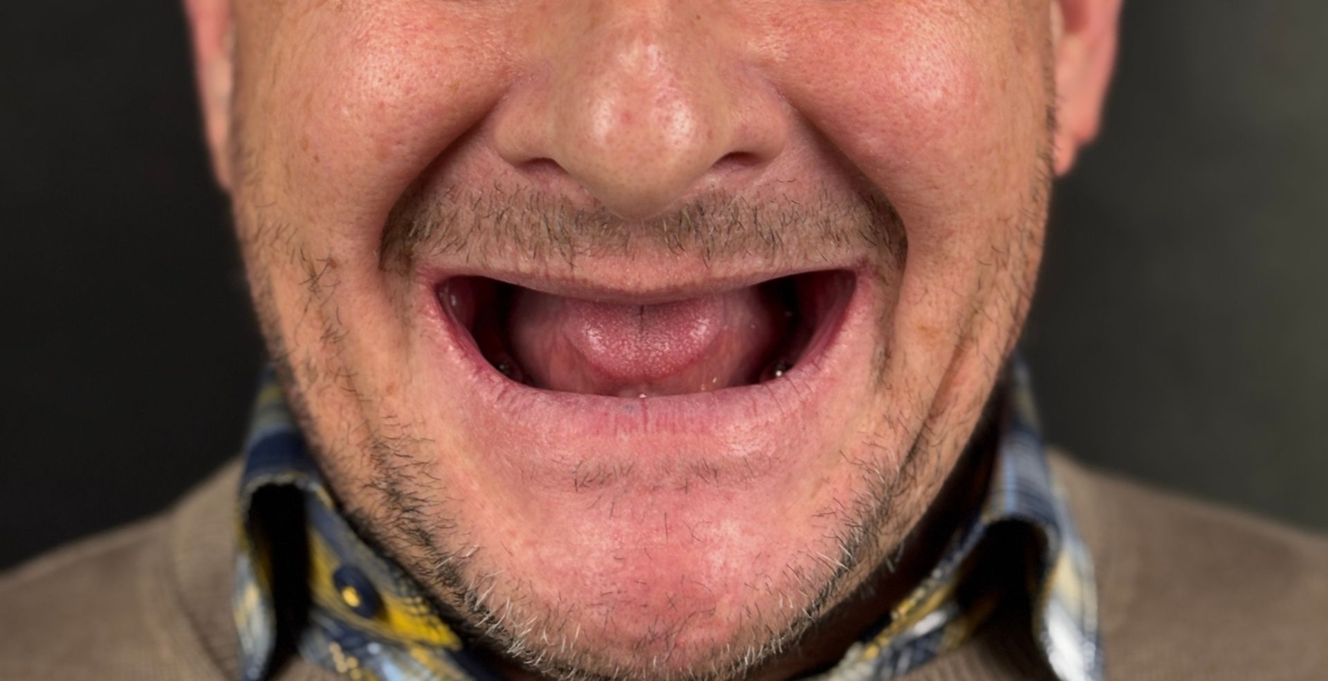 Estetică dentară MD Dental Pitești, înainte de smile design