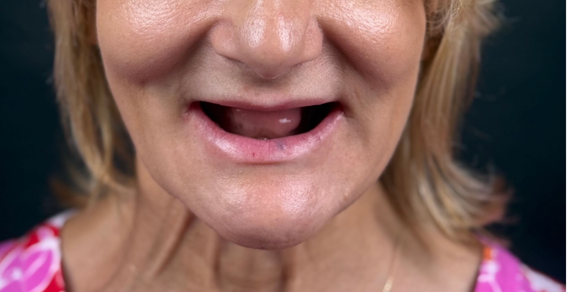 Reabilitare completă multidisciplinară MD Dental Pitești, înainte