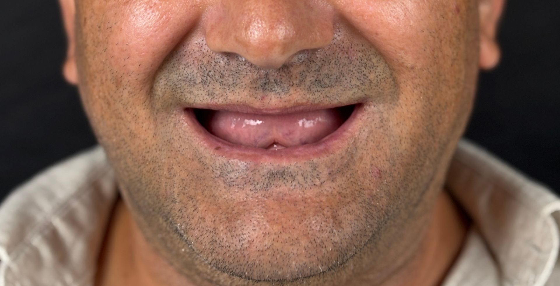Stare inițială tratament dental la MD Dental Pitești